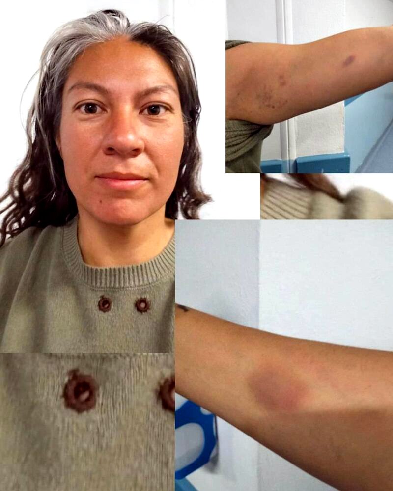 Activista de la Flotilla golpeada.