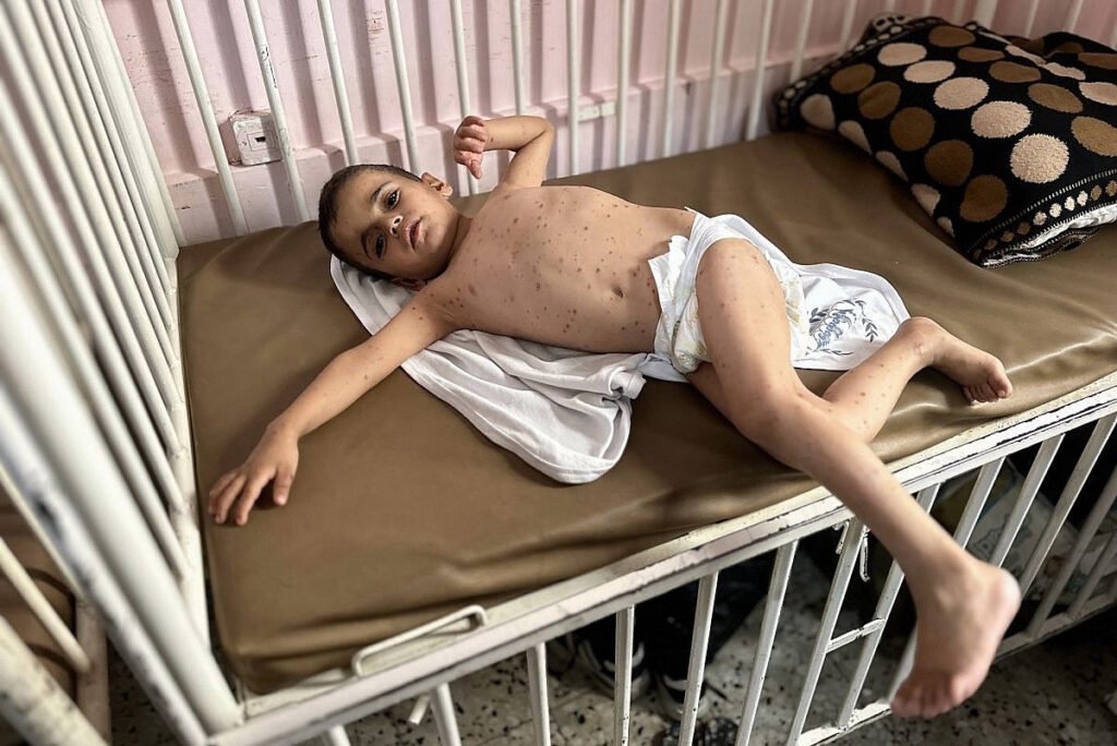 Un niño palestino que padece infecciones cutáneas y desnutrición severa recibe tratamiento en el Hospital Al-Nasser, en Khan Younis, al sur de la Franja de Gaza.