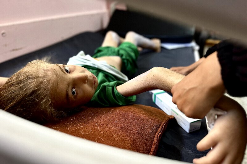 Huda Abu Al-Naja, de 12 años, recibe tratamiento por desnutrición en el Hospital Nasser de Gaza, el 25 de junio de 2025.
